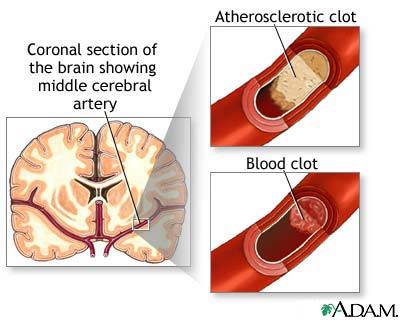 brain artery blockage