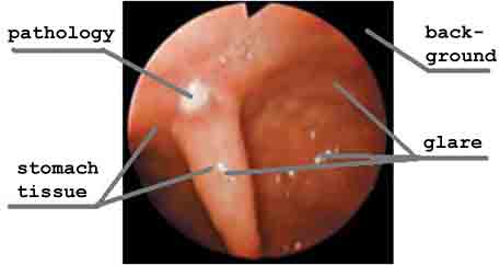 Figure 1 — Initial picture got during esophagogastroduodenoscopy.