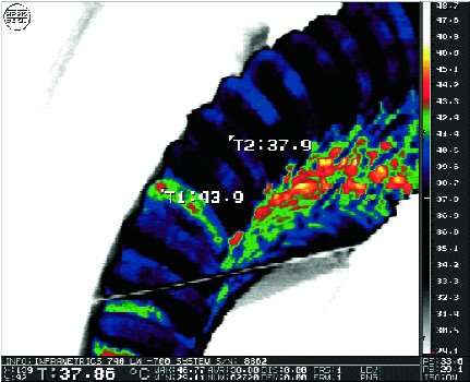 The thermogram 17.03.2000, the generator 6 GT TPS. The view from the turbine near the 11 hours (until the 1st resoldering), dT = 6C (Rmax = 6,8% between the branches A1 and A2 of phase A)