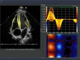 New software with ultrasound
