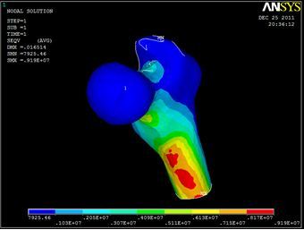 Figure 4   Stress distribution on a thigh bone 